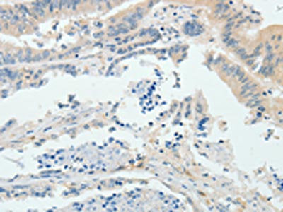 The image on the left is immunohistochemistry of paraffin-embedded Human colon cancer tissue using RPS6KB1 Antibody(RPS6KB1 Antibody) at dilution 1/25, on the right is treated with fusion protein. (Original magnification: ×200)Rabbit anti-Human RPS6KB1 Polyclonal Antibody