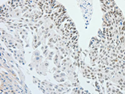 The image on the left is immunohistochemistry of paraffin-embedded Human cervical cancer tissue using the antibody Antibody) at dilution 1/25, on the right is treated with fusion protein. (Original magnification: ×200)Rabbit anti-Human RPS6KB1 Polyclonal Antibody