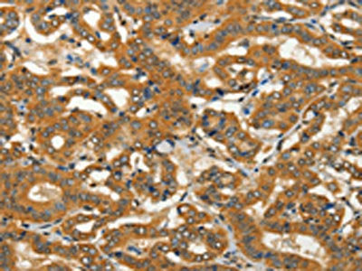 The image on the left is immunohistochemistry of paraffin-embedded Human thyroid cancer tissue using ADCY3 Antibody(ADCY3 Antibody) at dilution 1/50, on the right is treated with fusion protein. (Original magnification: ×200)Rabbit anti-Human ADCY3 Polyclonal Antibody