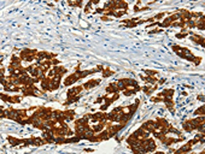 The image on the left is immunohistochemistry of paraffin-embedded Human colon cancer tissue using the antibody Antibody) at dilution 1/50, on the right is treated with fusion protein. (Original magnification: ×200)
