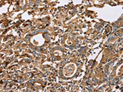 The image on the left is immunohistochemistry of paraffin-embedded Human gastric cancer tissue using LTF Antibody(LTF Antibody) at dilution 1/50, on the right is treated with fusion protein. (Original magnification: ×200)