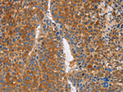 The image on the left is immunohistochemistry of paraffin-embedded Human liver cancer tissue using the antibody Antibody) at dilution 1/50, on the right is treated with fusion protein. (Original magnification: ×200)