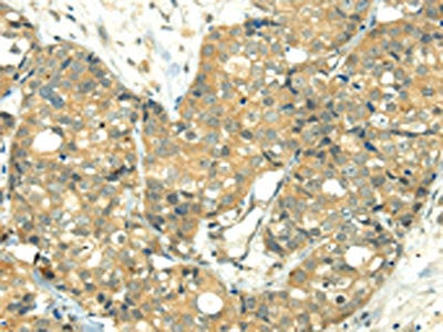 The image on the left is immunohistochemistry of paraffin-embedded Human breast cancer tissue using TRIM10 Antibody(TRIM10 Antibody) at dilution 1/35, on the right is treated with fusion protein. (Original magnification: ×200)Rabbit anti-Human TRIM10 Polyclonal Antibody