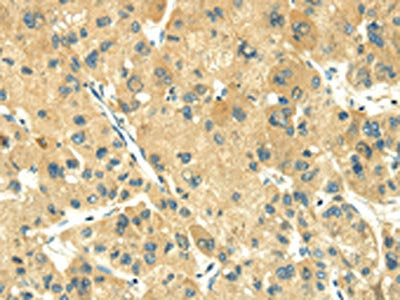 The image on the left is immunohistochemistry of paraffin-embedded Human liver cancer tissue using the antibody Antibody) at dilution 1/35, on the right is treated with fusion protein. (Original magnification: ×200)Rabbit anti-Human TRIM10 Polyclonal Antibody
