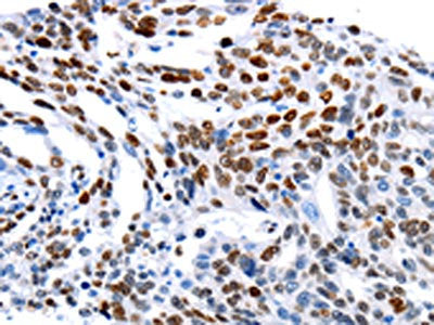The image on the left is immunohistochemistry of paraffin-embedded Human ovarian cancer tissue using MUTYH Antibody(MUTYH Antibody) at dilution 1/60, on the right is treated with fusion protein. (Original magnification: ×200)Rabbit anti-Human MUTYH Polyclonal Antibody