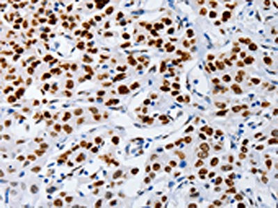 The image on the left is immunohistochemistry of paraffin-embedded Human lung cancer tissue using the antibody Antibody) at dilution 1/60, on the right is treated with fusion protein. (Original magnification: ×200)Rabbit anti-Human MUTYH Polyclonal Antibody