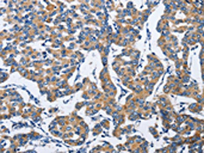 The image on the left is immunohistochemistry of paraffin-embedded Human breast cancer tissue using DUSP19 Antibody(DUSP19 Antibody) at dilution 1/30, on the right is treated with fusion protein. (Original magnification: ×200)Rabbit anti-Human DUSP19 Polyclonal Antibody