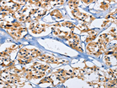 The image on the left is immunohistochemistry of paraffin-embedded Human thyroid cancer tissue using the antibody Antibody) at dilution 1/30, on the right is treated with fusion protein. (Original magnification: ×200)Rabbit anti-Human DUSP19 Polyclonal Antibody