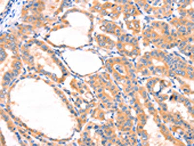 The image on the left is immunohistochemistry of paraffin-embedded Human thyroid cancer tissue using PRDX2 Antibody(PRDX2 Antibody) at dilution 1/80, on the right is treated with synthetic peptide. (Original magnification: ×200)Rabbit anti-Human PRDX2 Polyclonal Antibody