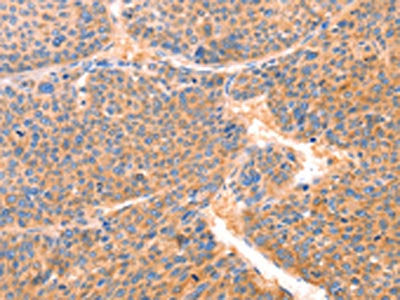 The image on the left is immunohistochemistry of paraffin-embedded Human liver cancer tissue using the antibody Antibody) at dilution 1/80, on the right is treated with synthetic peptide. (Original magnification: ×200)Rabbit anti-Human PRDX2 Polyclonal Antibody