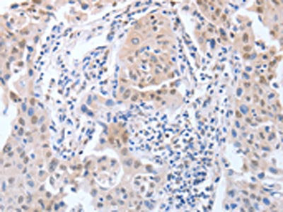 The image on the left is immunohistochemistry of paraffin-embedded Human lung cancer tissue using APEX1 Antibody(APEX1 Antibody) at dilution 1/20, on the right is treated with fusion protein. (Original magnification: ×200)Rabbit anti-Human APEX1 Polyclonal Antibody