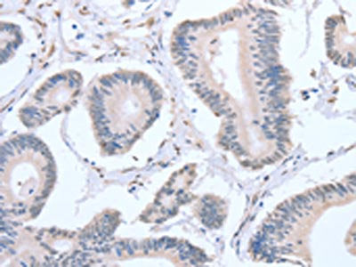 The image on the left is immunohistochemistry of paraffin-embedded Human colon cancer tissue using the antibody Antibody) at dilution 1/20, on the right is treated with fusion protein. (Original magnification: ×200)Rabbit anti-Human APEX1 Polyclonal Antibody