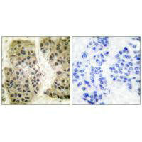 Immunohistochemical analysis of paraffin-embedded human breast carcinoma tissue using GANP antibody.