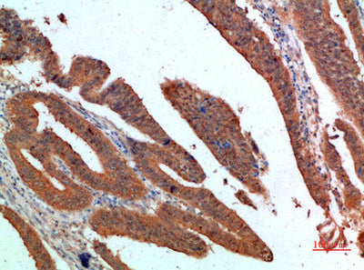 Immunohistochemical analysis of paraffin-embedded human-colon-cancer, antibody was diluted at 1:200Rabbit anti-Human PDGFC Polyclonal Antibody