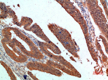 Immunohistochemical analysis of paraffin-embedded human-colon-cancer, antibody was diluted at 1:200Rabbit anti-Human PDGFC Polyclonal Antibody