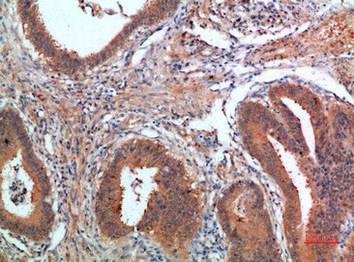 Immunohistochemical analysis of paraffin-embedded human-colon-cancer, antibody was diluted at 1:200Rabbit anti-Human PDGFC Polyclonal Antibody