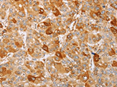 The image on the left is immunohistochemistry of paraffin-embedded Human liver cancer tissue using MCM5 Antibody(MCM5 Antibody) at dilution 1/40, on the right is treated with fusion protein. (Original magnification: ×200)