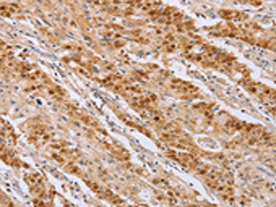 The image on the left is immunohistochemistry of paraffin-embedded Human gastic cancer tissue using the antibody Antibody) at dilution 1/40, on the right is treated with fusion protein. (Original magnification: ×200)
