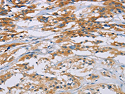 The image on the left is immunohistochemistry of paraffin-embedded Human thyroid cancer tissue using the antibody Antibody) at dilution 1/40, on the right is treated with fusion protein. (Original magnification: ×200)Rabbit anti-Human CD33 Polyclonal Antibody