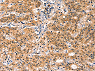 The image on the left is immunohistochemistry of paraffin-embedded Human gastric cancer tissue using EIF4G1 Antibody(EIF4G1 Antibody) at dilution 1/30, on the right is treated with synthetic peptide. (Original magnification: ×200)Rabbit anti-Human EIF4G1 Polyclonal Antibody