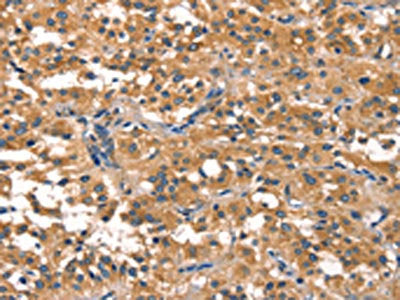 The image on the left is immunohistochemistry of paraffin-embedded Human thyroid cancer tissue using the antibody Antibody) at dilution 1/30, on the right is treated with synthetic peptide. (Original magnification: ×200)Rabbit anti-Human EIF4G1 Polyclonal Antibody
