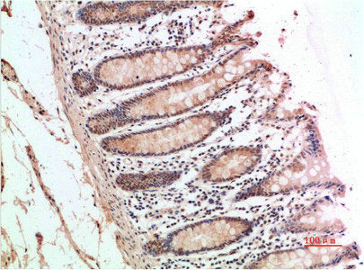 Immunohistochemical analysis of paraffin-embedded Human Colon Carcinoma Tissue using ATM Rabbit pAb diluted at 1:200.