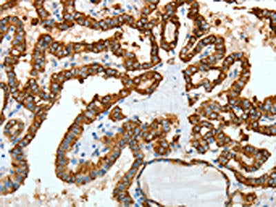 The image on the left is immunohistochemistry of paraffin-embedded Human thyroid cancer tissue using KRT18 Antibody(KRT18 Antibody) at dilution 1/30, on the right is treated with fusion protein. (Original magnification: ×200)