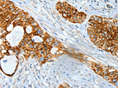 The image on the left is immunohistochemistry of paraffin-embedded Human cervical cancer tissue using the antibody Antibody) at dilution 1/30, on the right is treated with fusion protein. (Original magnification: ×200)