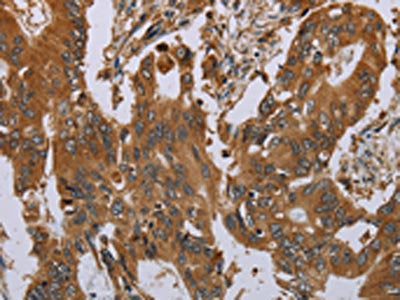 The image on the left is immunohistochemistry of paraffin-embedded Human colon cancer tissue using OSM Antibody(OSM Antibody) at dilution 1/40, on the right is treated with synthetic peptide. (Original magnification: ×200)Rabbit anti-Human OSM Polyclonal Antibody
