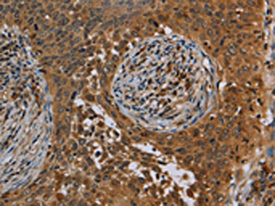 The image on the left is immunohistochemistry of paraffin-embedded Human cervical cancer tissue using the antibody Antibody) at dilution 1/40, on the right is treated with synthetic peptide. (Original magnification: ×200)Rabbit anti-Human OSM Polyclonal Antibody