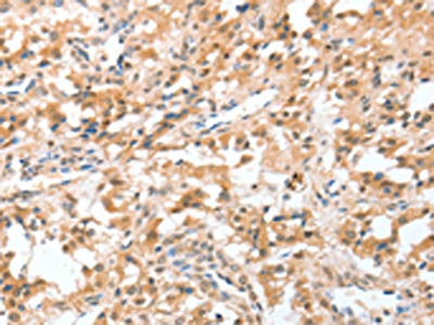 The image on the left is immunohistochemistry of paraffin-embedded Human thyroid cancer tissue using CIDEC Antibody(CIDEC Antibody) at dilution 1/50, on the right is treated with fusion protein. (Original magnification: ×200)Rabbit anti-Human CIDEC Polyclonal Antibody