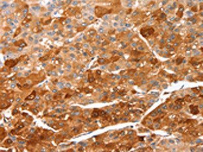 The image on the left is immunohistochemistry of paraffin-embedded Human liver cancer tissue using the antibody Antibody) at dilution 1/50, on the right is treated with fusion protein. (Original magnification: ×200)Rabbit anti-Human CIDEC Polyclonal Antibody