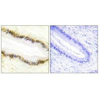 Immunohistochemistry analysis of paraffin-embedded human cervix carcinoma tissue using NR2F6 antibody.Rabbit anti-Human NR2F6 Polyclonal Antibody