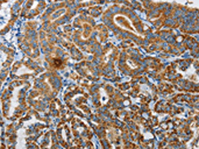 The image on the left is immunohistochemistry of paraffin-embedded Human thyroid cancer tissue using UPF1 Antibody(UPF1 Antibody) at dilution 1/35, on the right is treated with synthetic peptide. (Original magnification: ×200)Rabbit anti-Human UPF1 Polyclonal Antibody