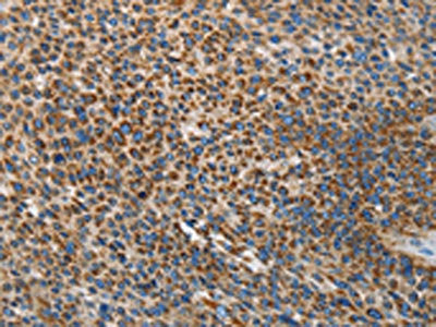 The image on the left is immunohistochemistry of paraffin-embedded Human liver cancer tissue using the antibody Antibody) at dilution 1/35, on the right is treated with synthetic peptide. (Original magnification: ×200)Rabbit anti-Human UPF1 Polyclonal Antibody