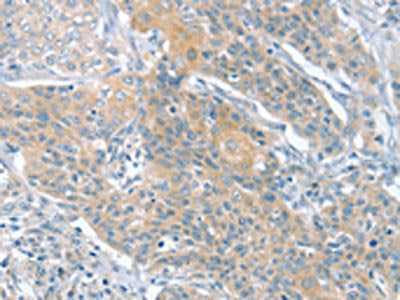 The image on the left is immunohistochemistry of paraffin-embedded Human cervical cancer tissue using SLIT2 Antibody(SLIT2 Antibody) at dilution 1/30, on the right is treated with synthetic peptide. (Original magnification: ×200)Rabbit anti-Human SLIT2 Polyclonal Antibody