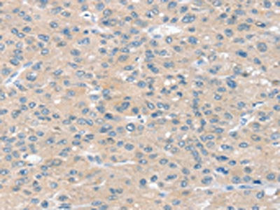 The image on the left is immunohistochemistry of paraffin-embedded Human liver cancer tissue using the antibody Antibody) at dilution 1/30, on the right is treated with synthetic peptide. (Original magnification: ×200)Rabbit anti-Human SLIT2 Polyclonal Antibody