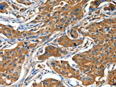 The image on the left is immunohistochemistry of paraffin-embedded Human lung cancer tissue using BAG3 Antibody(BAG3 Antibody) at dilution 1/25, on the right is treated with fusion protein. (Original magnification: ×200)