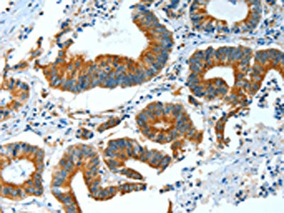 The image on the left is immunohistochemistry of paraffin-embedded Human colon cancer tissue using the antibody Antibody) at dilution 1/25, on the right is treated with fusion protein. (Original magnification: ×200)