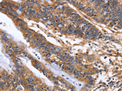 The image on the left is immunohistochemistry of paraffin-embedded Human colon cancer tissue using ITGB1 Antibody(ITGB1 Antibody) at dilution 1/60, on the right is treated with fusion protein. (Original magnification: ×200)