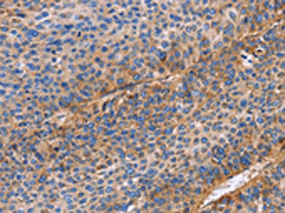 The image on the left is immunohistochemistry of paraffin-embedded Human liver cancer tissue using the antibody Antibody) at dilution 1/60, on the right is treated with fusion protein. (Original magnification: ×200)