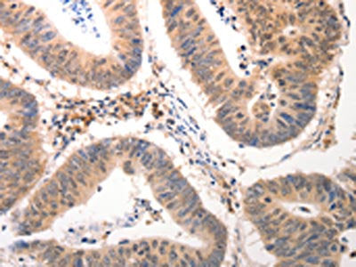 The image on the left is immunohistochemistry of paraffin-embedded Human colon cancer tissue using CDC6 Antibody(CDC6 Antibody) at dilution 1/25, on the right is treated with synthetic peptide. (Original magnification: ×200)Rabbit anti-Human CDC6 Polyclonal Antibody