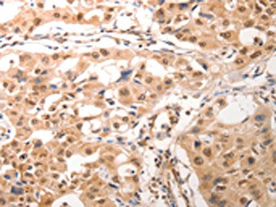 The image on the left is immunohistochemistry of paraffin-embedded Human lung cancer tissue using the antibody Antibody) at dilution 1/25, on the right is treated with synthetic peptide. (Original magnification: ×200)Rabbit anti-Human CDC6 Polyclonal Antibody