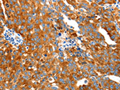 The image on the left is immunohistochemistry of paraffin-embedded Human ovarian cancer tissue using GDF6 Antibody(GDF6 Antibody) at dilution 1/20, on the right is treated with synthetic peptide. (Original magnification: ×200)Rabbit anti-Human GDF6 Polyclonal Antibody