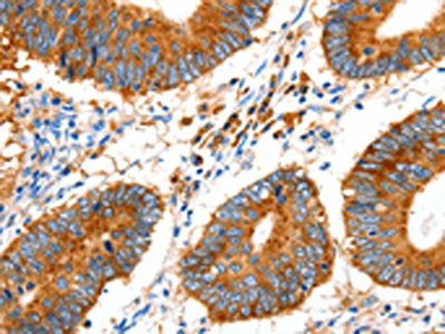 The image on the left is immunohistochemistry of paraffin-embedded Human colon cancer tissue using the antibody Antibody) at dilution 1/20, on the right is treated with synthetic peptide. (Original magnification: ×200)Rabbit anti-Human GDF6 Polyclonal Antibody