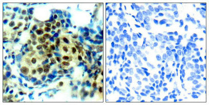Immunohistochemical analysis of paraffin-embedded human breast carcinoma tissue using p44/42 MAP Kinase (Phospho-Thr202) Antibody (left) or the same antibody preincubated with blocking peptide (right).