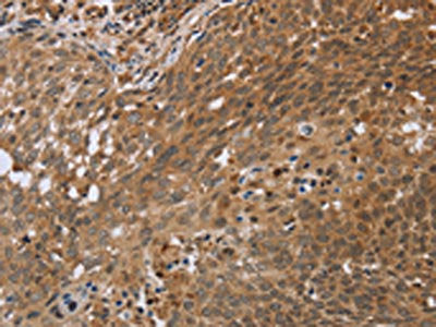 The image on the left is immunohistochemistry of paraffin-embedded Human cervical cancer tissue using NDUFS2 Antibody(NDUFS2 Antibody) at dilution 1/35, on the right is treated with synthetic peptide. (Original magnification: ×200)Rabbit anti-Human NDUFS2 Polyclonal Antibody