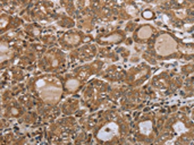 The image on the left is immunohistochemistry of paraffin-embedded Human thyroid cancer tissue using the antibody Antibody) at dilution 1/35, on the right is treated with synthetic peptide. (Original magnification: ×200)Rabbit anti-Human NDUFS2 Polyclonal Antibody