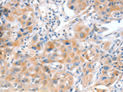 The image on the left is immunohistochemistry of paraffin-embedded Human lung cancer tissue using the antibody Antibody) at dilution 1/20, on the right is treated with fusion protein. (Original magnification: ×200)