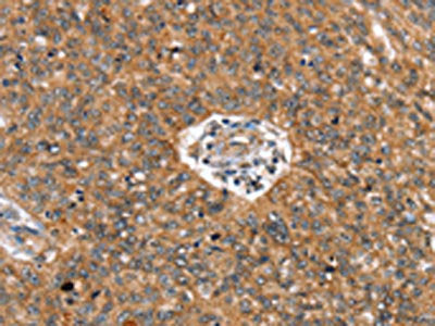 The image on the left is immunohistochemistry of paraffin-embedded Human ovarian cancer tissue using CADM4 Antibody(CADM4 Antibody) at dilution 1/25, on the right is treated with synthetic peptide. (Original magnification: ×200)